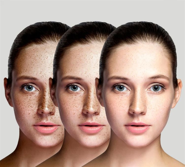 Cosmelan Depigmentation Treatment
