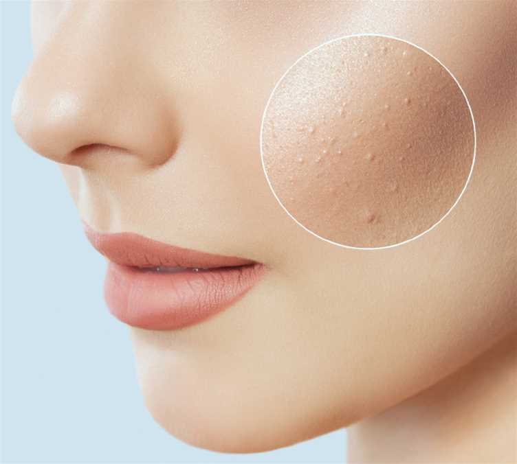 Aesthetic services - Acne Treatments