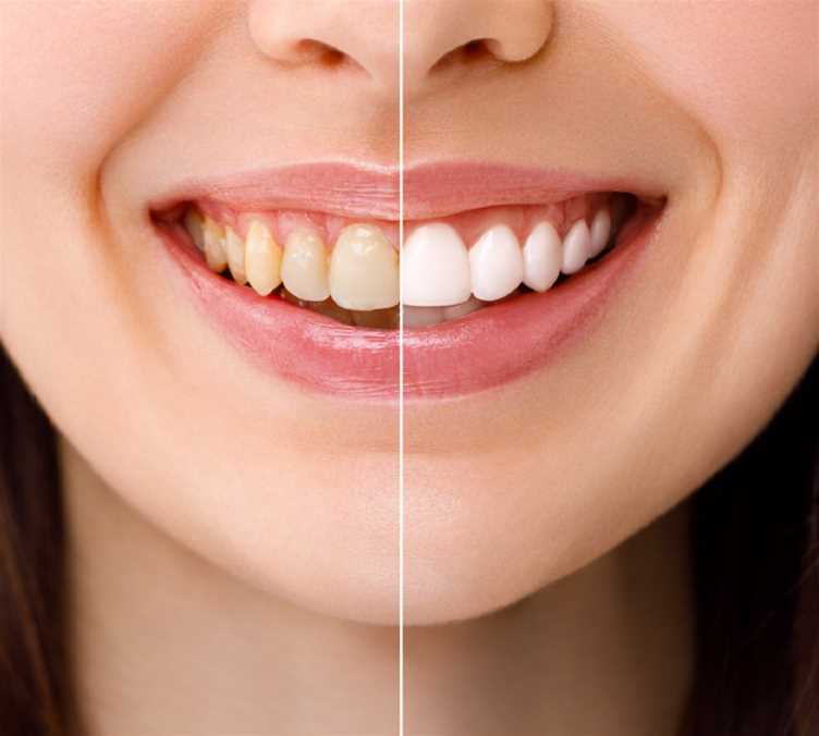 Aesthetic services - Teeth Whitening